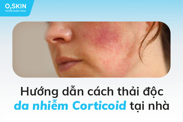 Hướng dẫn cách thải độc da nhiễm Corticoid tại nhà