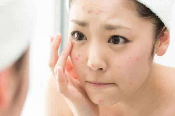 Hiệu quả trị mụn của IPL lên đến 90%