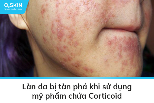 Làn da bị tàn phá khi sử dụng mỹ phẩm chứa Corticoid