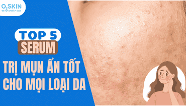 Top 05 serum trị mụn ẩn tốt cho mọi loại da