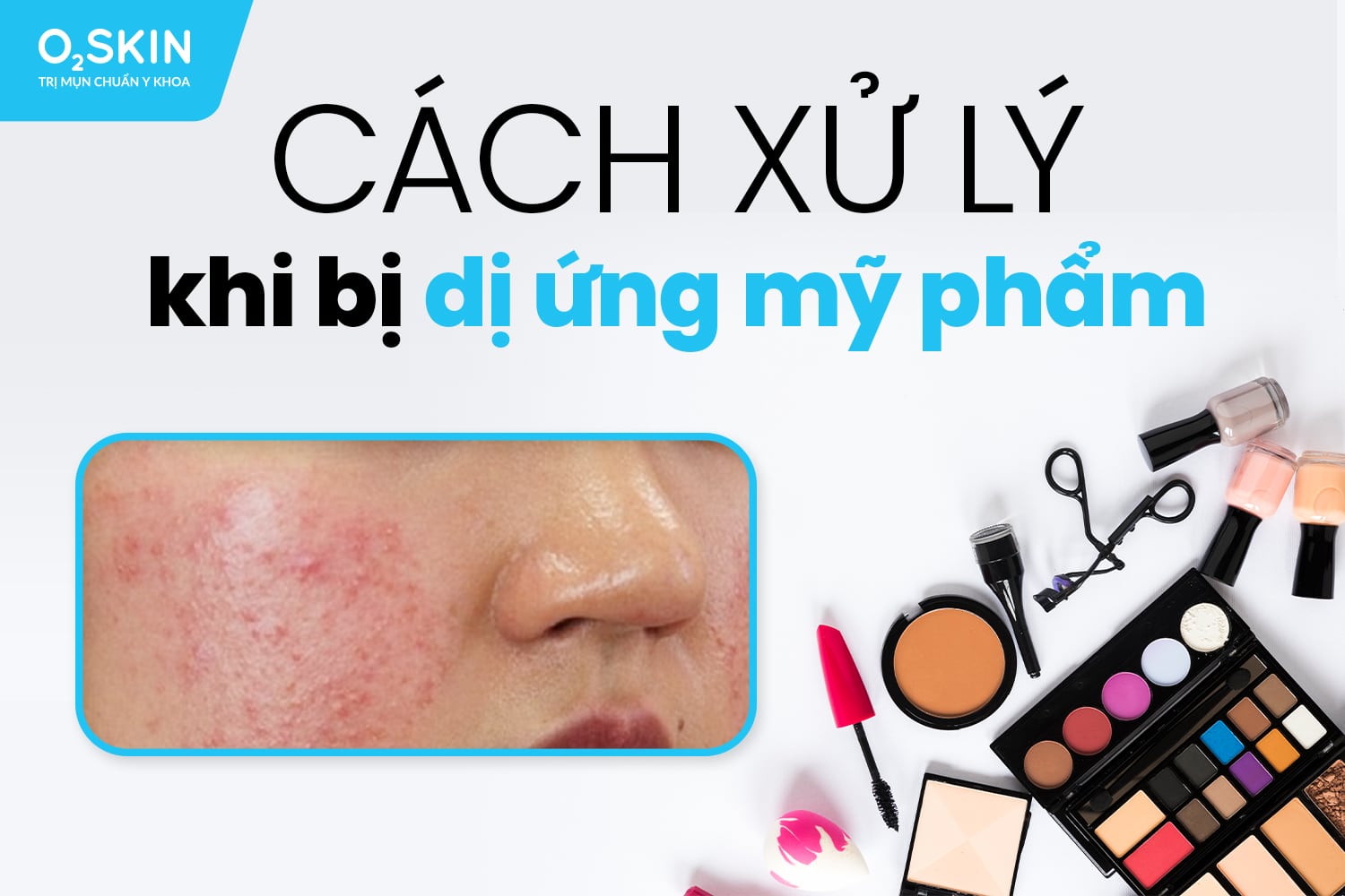 Cách xử lý khi bị dị ứng mỹ phẩm: Hướng dẫn chi tiết và hiệu quả