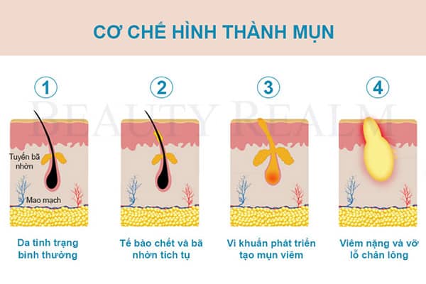 Cơ chế hình thành mụn