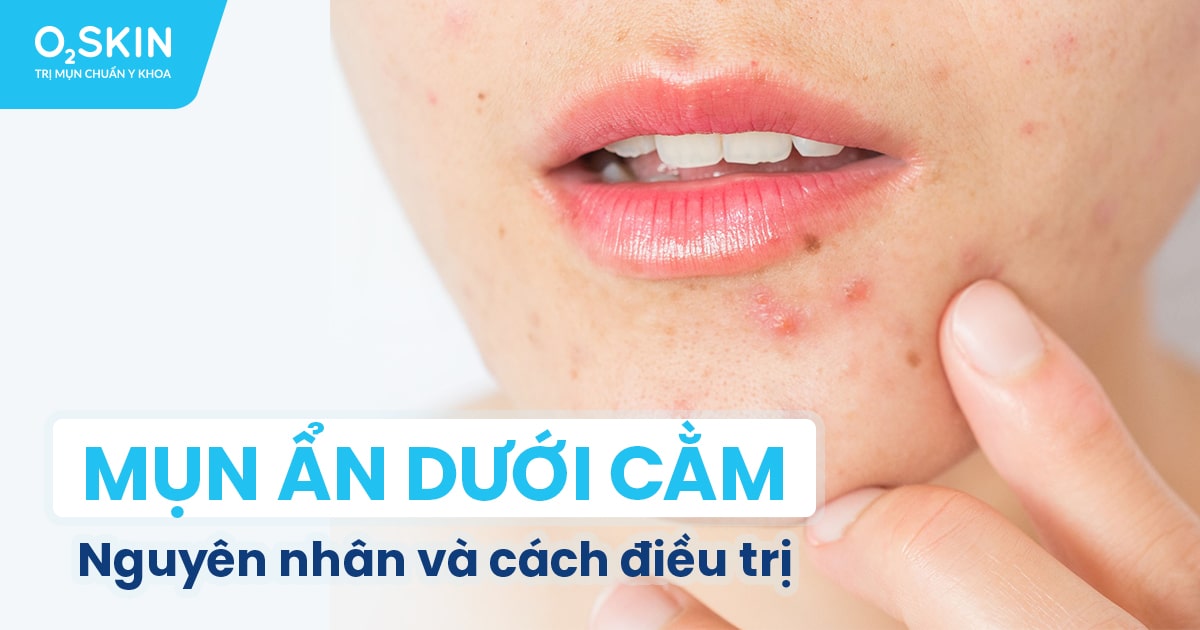 Cách trị mụn ẩn ở cằm hiệu quả - Giải pháp tốt nhất cho làn da