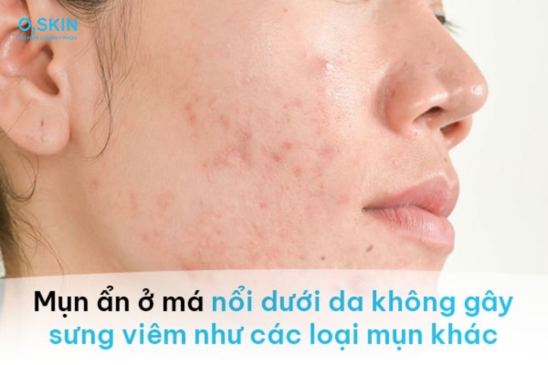 mụn ẩn ở má là gì