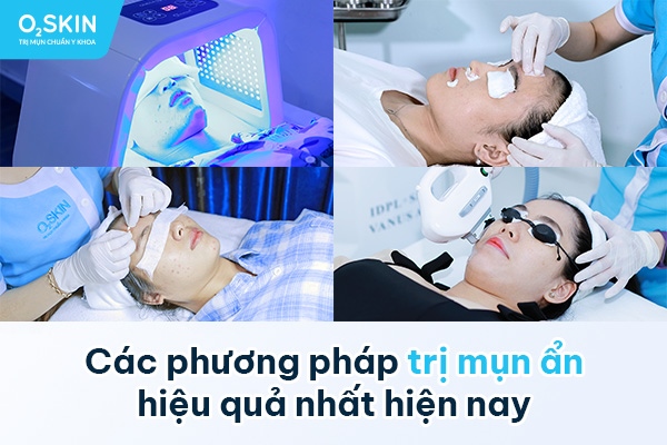 bị mụn ẩn ở má