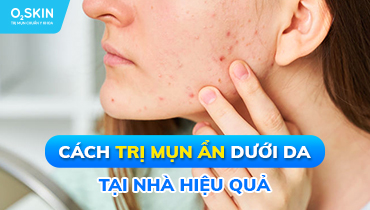 5 Cách trị mụn ẩn dưới da tại nhà hiệu quả