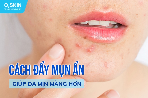 đẩy mụn ẩn