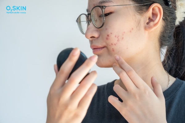 Thâm đỏ sau mụn do đâu