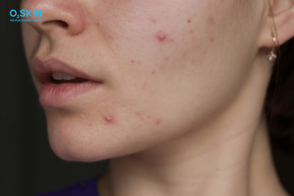 Thâm đỏ sau mụn