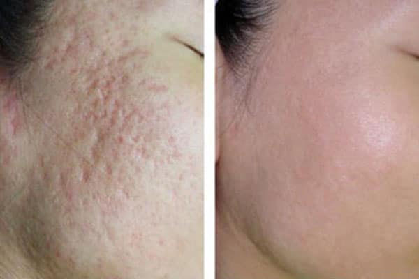 Thông Tin Về Laser CO2 Fractional Bao Nhiêu Lần