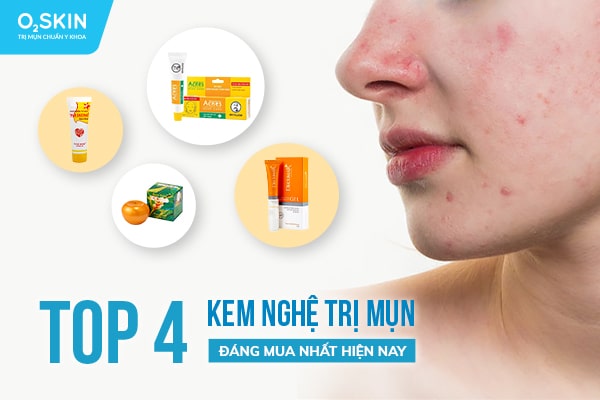 Top 4 kem nghệ trị mụn đáng mua nhất hiện nay