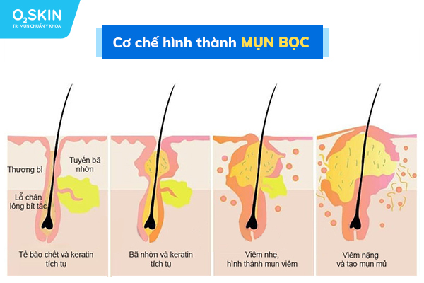 Cơ chế hình thành mụn bọc