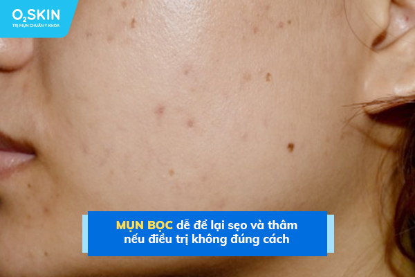 Mụn bọc dễ để lại sẹo và thâm nếu điều trị không đúng cách