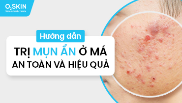 Mụn ẩn ở má do đâu? Điều trị và ngăn ngừa thế nào cho hiệu quả?