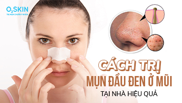 Top 9 cách trị mụn đầu đen ở mũi tại nhà hiệu quả