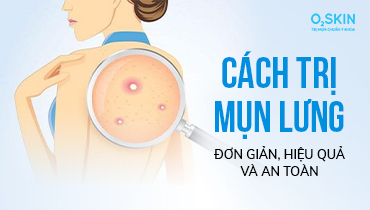 TOP 6 cách trị mụn lưng tại nhà hiệu quả và tiết kiệm nhất