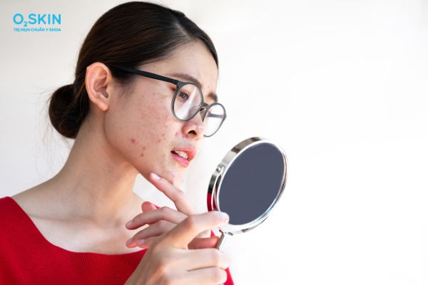 Cách trị mụn viêm đỏ