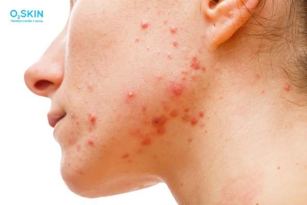 Có nên đi nặn mụn ở spa không