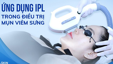 Điều Trị Mụn Viêm Sưng Bằng Công Nghệ IPL