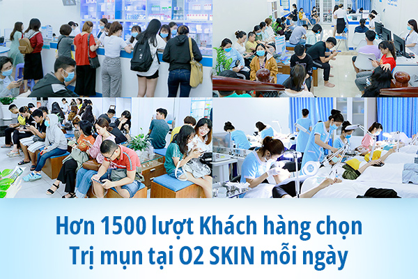 Hơn 1500 lượt Khách hàng chọn Trị mụn tại O2 SKIN mỗi ngày