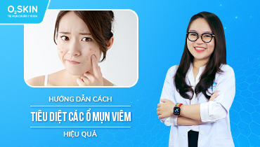 Tiêu diệt các ổ mụn viêm hiệu quả