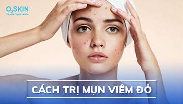 Top 7 cách trị mụn viêm đỏ tại nhà hiệu quả