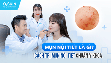 Mụn nội tiết: Dấu hiệu, nguyên nhân và cách điều trị