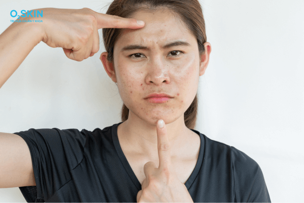 bị mụn nên đi da liễu hay đi spa Mụn trứng cá là gì