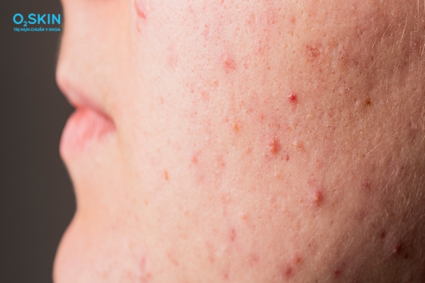 Hình ảnh mụn viêm đỏ