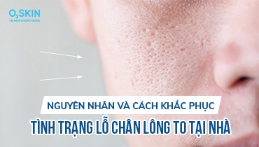 Cách trị lỗ chân lông to hiệu quả nhất hiện nay