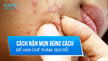 Có nên nặn mụn không? Những hậu quả khi nặn mụn sai cách