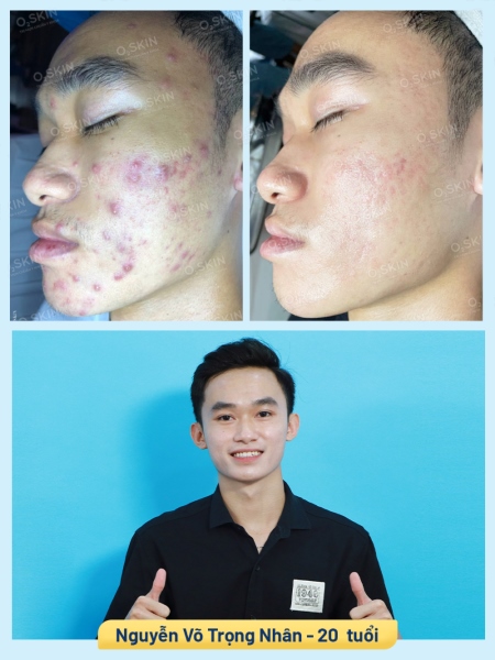 Hiệu quả trị mụn bọc tại O2 SKIN của bạn Trọng Nhân