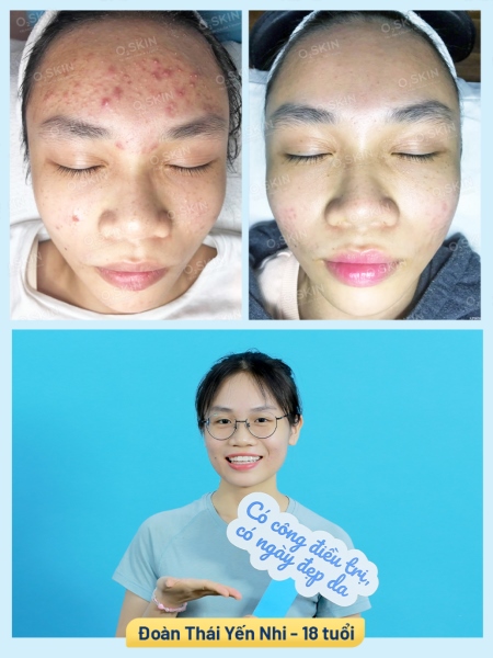 Hiệu quả trị mụn bọc tại O2 SKIN của bạn Yến Nhi