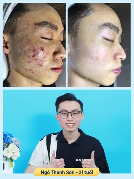 Hiệu quả trị mụn bọc tại O2 SKIN của bạn Thanh Sơn