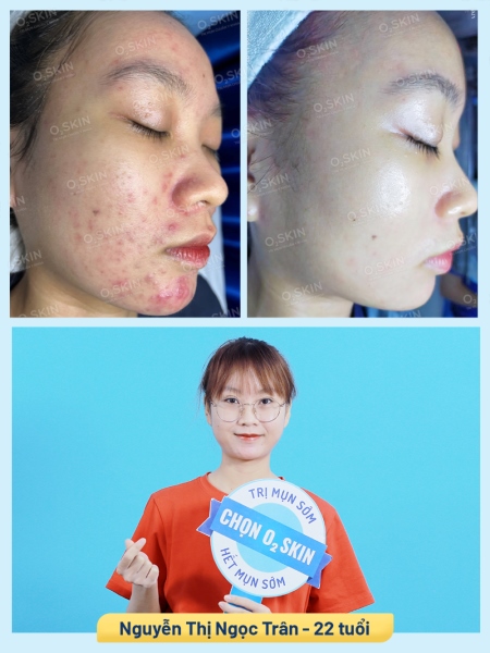 Hiệu quả trị mụn bọc tại O2 SKIN của bạn Ngọc Trân