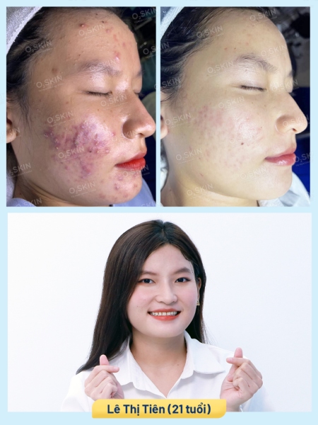 Hình ảnh Tiên Lê sau 3 tháng điều trị mụn bọc tại O2 SKIN