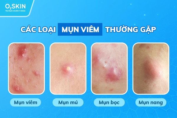 Các loại mụn viêm thường gặp