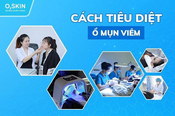 Cách tiêu diệt ổ mụn viêm