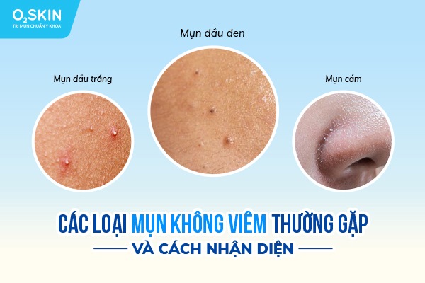 Các loại mụn không viêm thường gặp và cách nhận diện