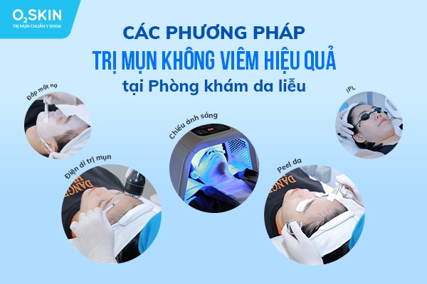 Top 6 phương pháp trị mụn không viêm hiệu quả tại Phòng khám da liễu