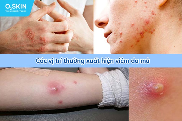 Các vị trí thường xuất hiện viêm da mụn mủ