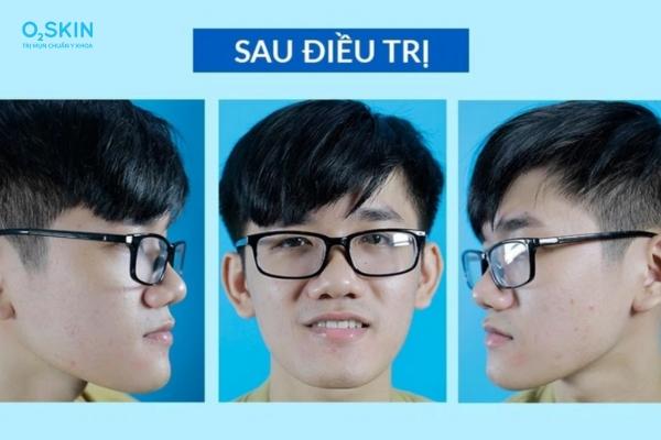 Chữa mụn đầu trắng ở má