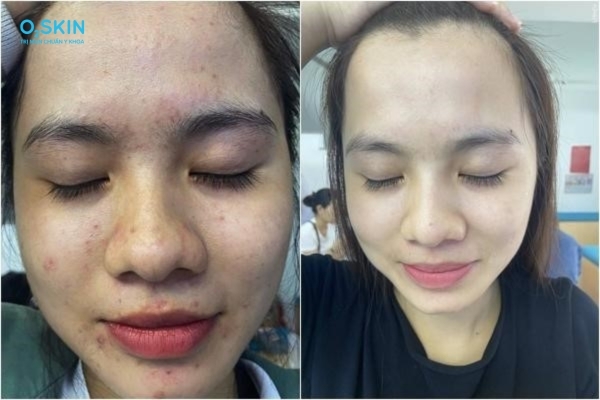 Chữa mụn đầu trắng trên trán