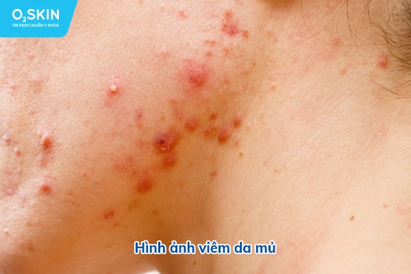 Hình ảnh viêm da mủ