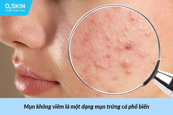 Mụn không viêm là một dạng mụn trứng cá phổ biến