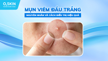 cách trị mụn đầu trắng