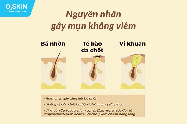 Nguyên nhân gây mụn không viêm