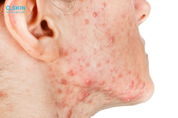 Nguyên nhân nổi mun ở quai hàm