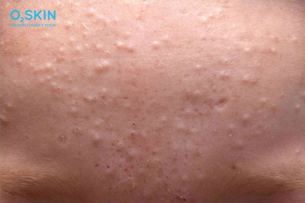 Nhận biết mụn đầu trắng trên trán