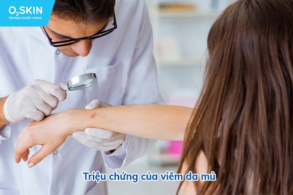 Triệu chứng của viêm da mủ